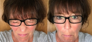 Multiple Sklerose und Schönheit